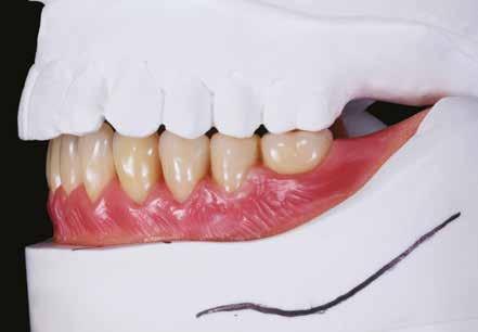 Technika Proteza overdenture fot. 25 fot. 26 fot. 27 jest stale monitorowany przy użyciu szablonów silikonowych (fot. 31).