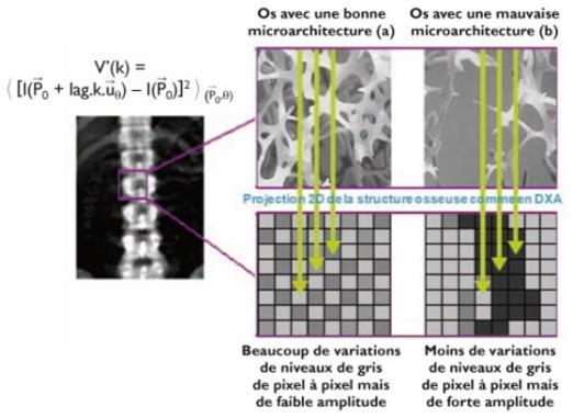 The Trabecular Bone Score is associated with bone mineral density, markers of bone turnover and prevalent fracture in patients with chronic kidney disease stages 5 and 5D Aleksova J i inni Ocena
