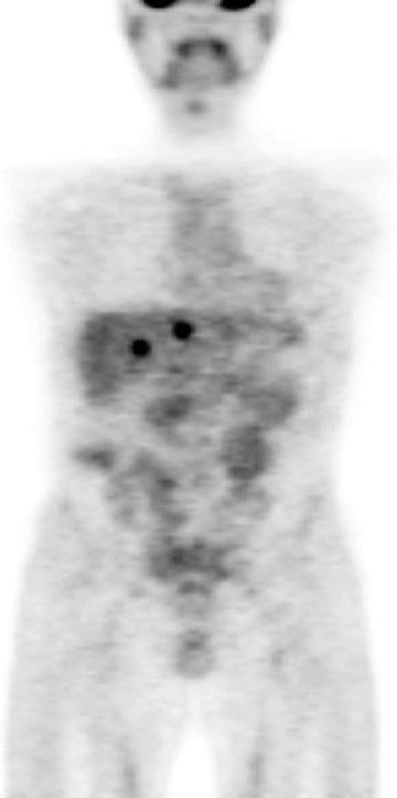 biologia guza - PET 18F FDG Uptake of Hepatocellular Carcinoma on PET Predicts Microvascular Tumor Invasion in Liver Transplant Patients Wizualizacja HCC w wątrobie świadczy o znacznej agresywności