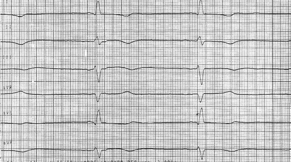 kardiologia 5-2007 dobra.qxp 2007-05-29 16:11 Page 578 578 Małgorzata Kurpesa et al. Rycina 1. EKG pacjentki z dnia przyjęcia do kliniki. Lewogram, rytm zatokowy, miarowy, o częstotliwości 50/min.