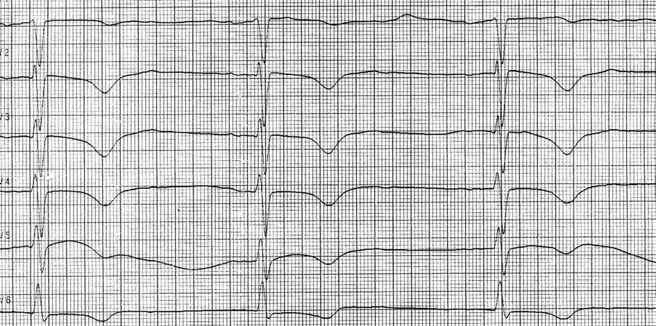 W EKG lewogram patologiczny, rytm zatokowy, miarowy, o częstotliwości 50/min, ujemne załamki T w odprowadzeniach I, II, III, avf, V 1 V 6 (Rycina 1.).