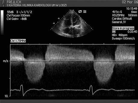 kardiologia 5-2007 dobra.qxp 2007-05-29 16:11 Page 579 Zaawansowana stenoza aortalna u 78-letniej kobiety 579 zaś prędkość przepływu przez zastawkę 7,1 m/s.