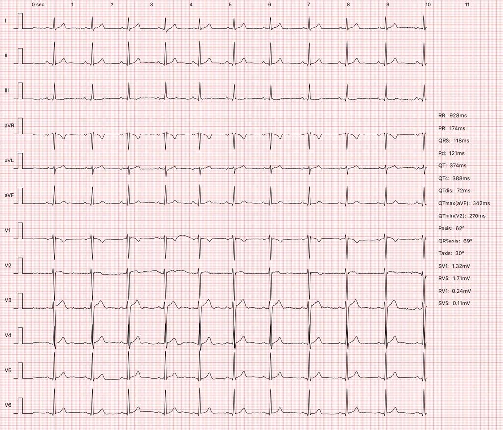 W EKG: