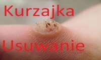 Leczenie kurzajek (brodawek wirusowych) Nie istnieją jak dotąd leki specyficznie działające na wirusa HPV.
