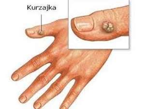 Kurzajki powstają w wyniku zakażenia wirusem HPV.