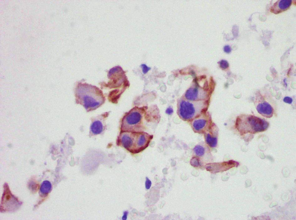 MIEJSCE A B C D PATOMORFOLOGII W TERAPII CELOWANEJ RAKA PŁUCA Rycina 1. Immunohistochemiczne oznaczenie EGFR.