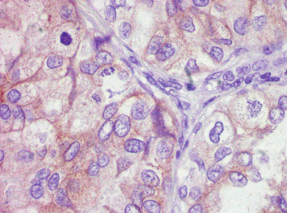 materiał pooperacyjny, 3+, 200 Ograniczenia oznaczeń immunohistochemicznych wynikają zarówno z rodzaju, jak i sposobu pobierania materiału [16, 17].