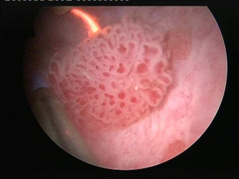 ENDOSKOPOWE 5 + EW.