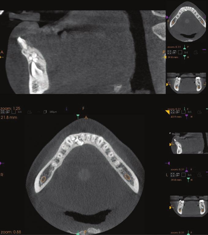 CBCT uwidaczniające pozycję zmiany i zatrzymanego stałego zęba siecznego bocznego żuchwy po stronie prawej W badaniu histopatologicznym potwierdzono wstępną diagnozę: zębiak zestawny.