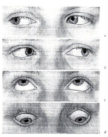Stereopsja Jednoczesna percepcja jest to zdolność spostrzegania jednocześnie dwóch różnych obrazów, z których jeden tworzy się na siatkówce prawego oka, a drugi na siatkówce lewego oka.