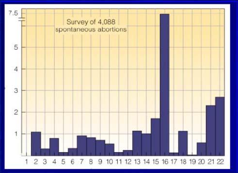 12. Trisomia 18: zespół Edwardsa Prenatalne i postnatalne opóźnienie wzrostu.