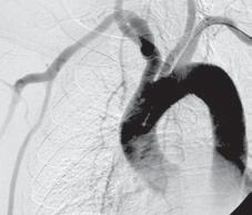 A. Schröder et al. Graft infection after axillobifemoral Dacron-bypass Polish Surgery 2001, 3, 3 Rycina 4a, 4b, 4c. Figures 4a, 4b, 4c.