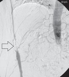 żylnym Angiography of the axillobifemoral autologous graft 17 months after surgery: stenosis (arrow) at the distal portion of the endarterectomised superficial femoral artery graft close to the