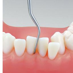 PERIODONTOLOGIA Do usuwania: kamienia z wąskich przestrzeni