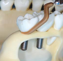 PERIODONTOLOGIA (UTRZYMANIE W CZYSTOŚCI) V-P12 dłuższa wersja popularnej końcówki skalera V-P10.