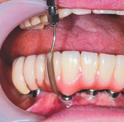 Przeznaczone do leczenia dalszych powierzchni zębów trzonowych i obszarów zatrzonowych, ponieważ czubek końcówki
