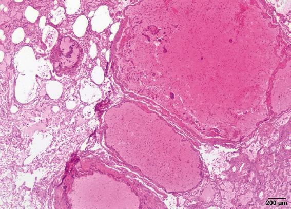 Prace kliniczne i kazuistyczne Wycinki zmienionych narządów pobrano do badania histopatologicznego, utrwalono w formalinie, zatopiono w parafinie i poddano rutynowej obróbce histopatologicznej.