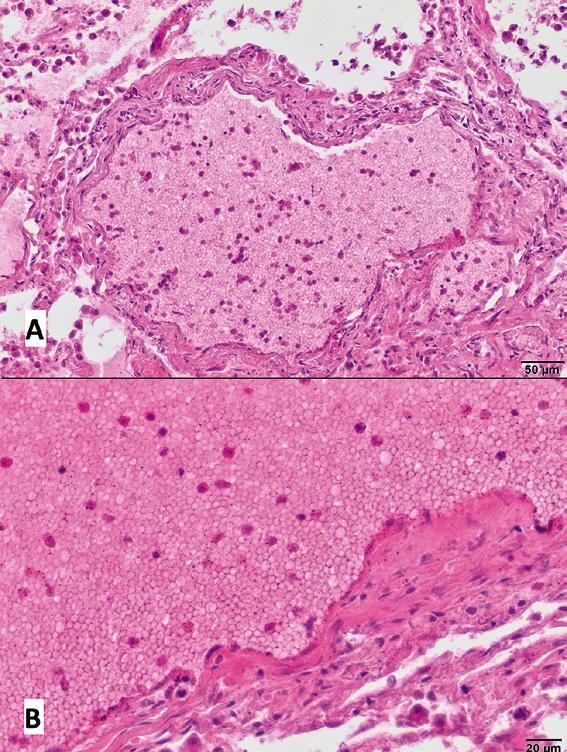 Badanie histopatologiczne wycinków pobranych z płuc wykazało obecność licznych różnej wielkości, od 0,25 do 25 mm, zmian jamistych (ryc.
