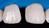 Cienka warstwa odcienia Enamel A1 stanowiła wierzchnią warstwę tej odbudowy, a także jej krawędź sieczną