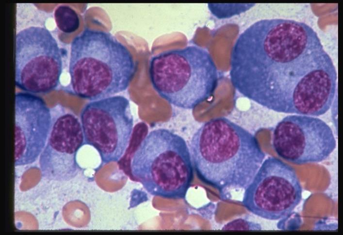 Szpiczak plazmocytowy Trzeci najczęściej występujący nowotwór hematologiczny Białko