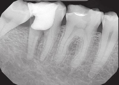 2 Praktyka DENTAL TRIBUNE Polish Edition Rozwiązywanie problemów endodontycznych Grzegorz Witkowski Celem leczenia endodontycznego jest przeciwdziałanie zapaleniu i infekcji systemu kanałów