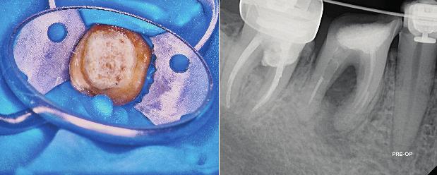 Technika obturacji również jest istotnym elementem całego postępowania. Odpowiedni jej dobór wpływa na mniej lub bardziej trójwymiarowe wypełnienie przestrzeni endodontycznej. Ostatnio mamy Ryc.