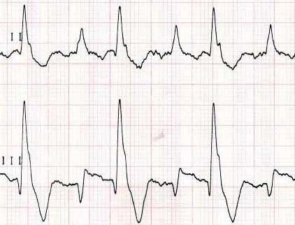 Choroby Serca i Naczyń 2015, tom 12, nr 6 KOMENTARZ Można by rzec, że jest to typowy przypadek dyżurowy. Prześledźmy raz jeszcze te trzy zapisy EKG.