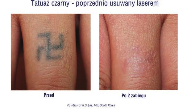 Ryc. 8. Przykład skuteczności działania impulsów pikosekundowych - tatuaż czarny, poprzednio usuwany laserem nanosekundowym. Stan po trzech zabiegach laserem LUTRONIC Pico Plus.