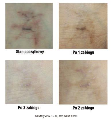 Po trze ba od do 4 za bie gów, co - 4 ty go dnie. Sku tecz ne pa ra me try: dłu gość fa li 1064 nm, plam ka 4-6 mm, gę stość ener gii od 1,8 do,4 J/cm.