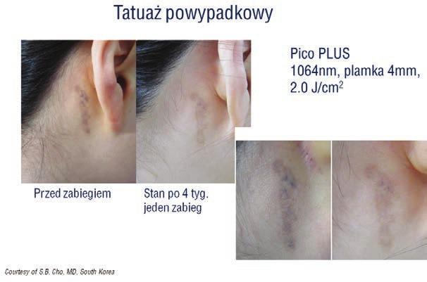 Tab.. Parametry zabiegów usuwania tatuaży powypadkowych laserem pikosekundowym Nd:YAG Pico Plus i ocena wyników. Plamka Gęstość energii J/cm Liczba zabiegów Odstęp między zabiegami tyg.