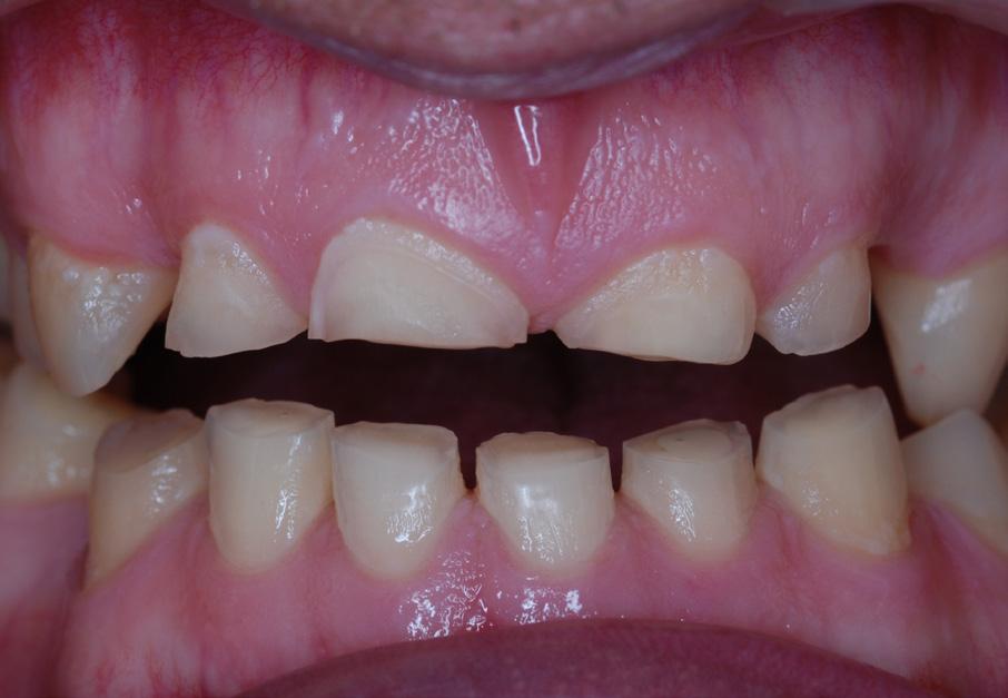 Przed leczeniem zdjęcie w odwiedzeniu żuchwy. Ryc. 4.