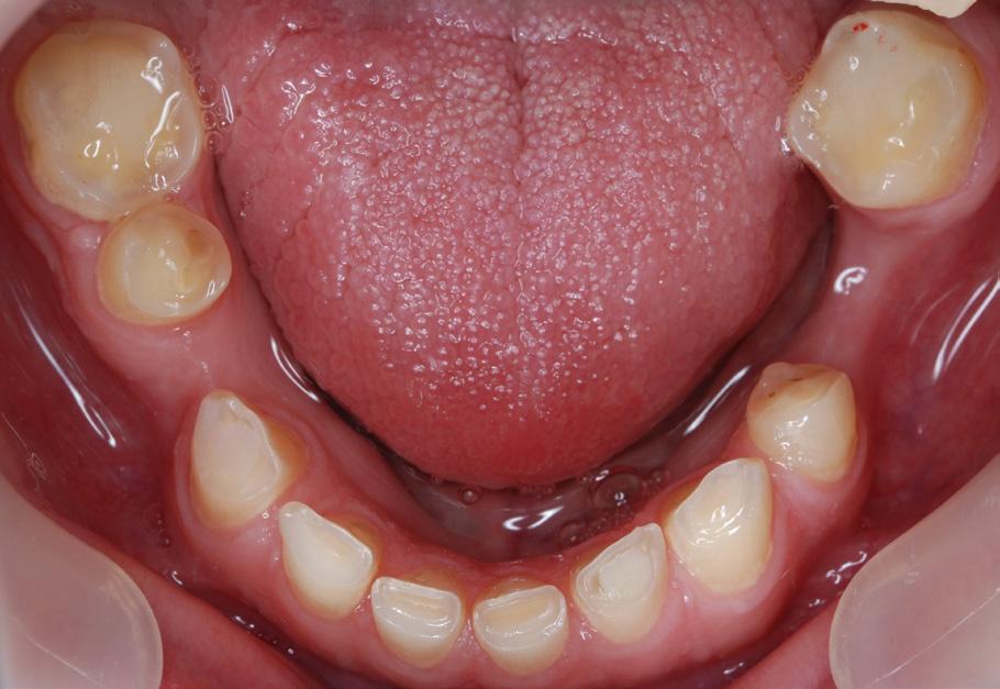 Ryc. 7. Przed leczeniem zdjęcie w okluzji nawykowej strona lewa.