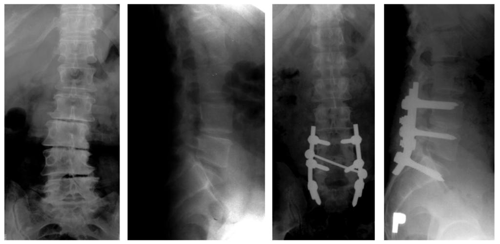 decompression of L4-S1 posterolateral fixation, segmental