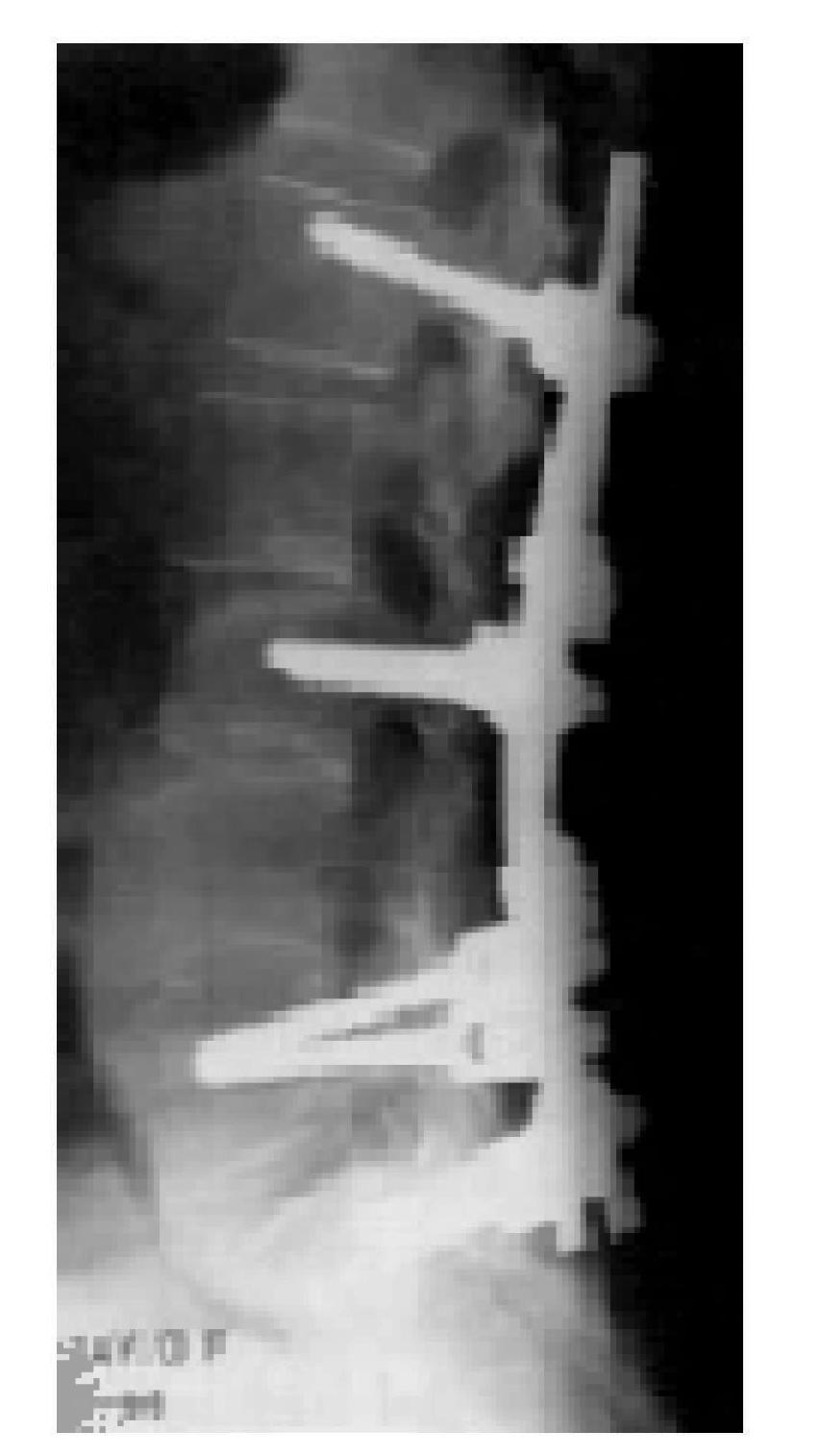 lordosis. Fig. 7. F. 59 y.o. Slight degenerative lumbar