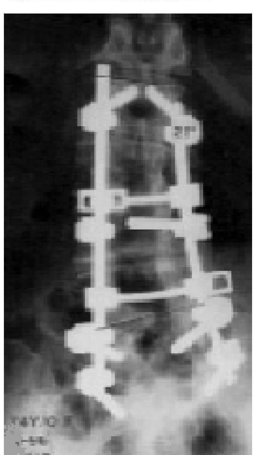 stabilization spondylodesis, restoration of lumbar lordosis. Fig.