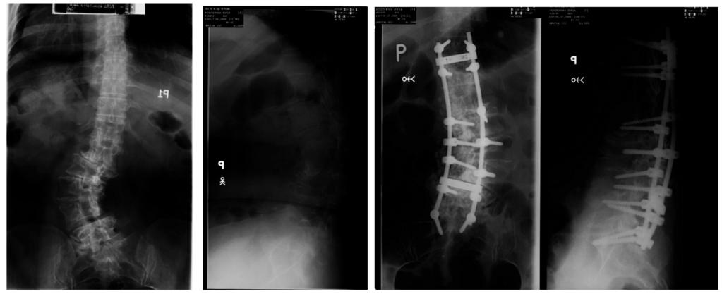 Degenerative lumbar scoliosis Cobb angle 48º, central, lateral