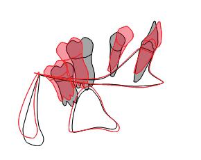 the palatal plane. Sagittal and vertical changes can be observed.