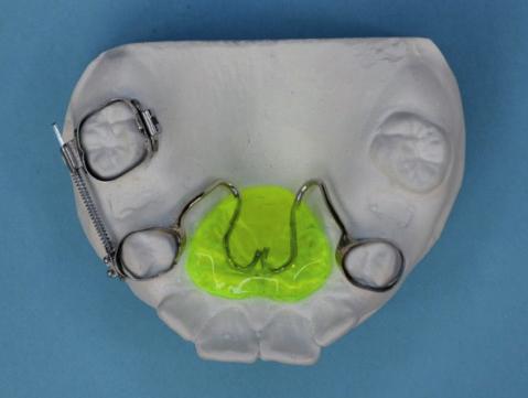 O.N. F 14y 5m 5m Y 5. Z.J. F 11y 10m 3m Y 6. T.A. F 10y 11m 3m N Fig. 1. The Distal Driver; a Distal Driver in situ occlusal view, b Distal Driver in situ lateral view, c elements of the Distal Driver appliance.