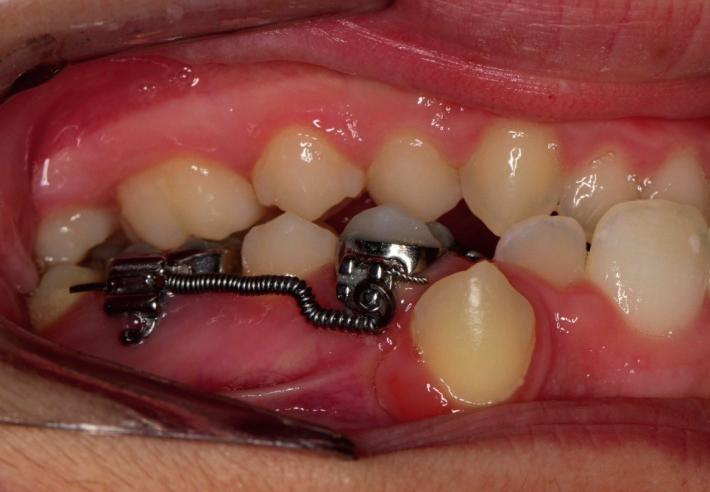 Dental and skeletal changes after intraoral molar distalization using... J Stoma 20