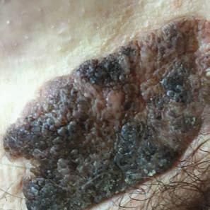 Ryc. 12. Brodawka łojotokowa w okolicy łonowej. Ryc. 13. Obraz dermatoskopowy zmiany. Ryc. 14.