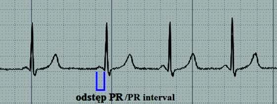 Zespoły preekscytacji u dzieci i młodzieży 181 Ryc. 2. Fragment zapisu EKG przedstawiający skrócony odstęp PR w zespole LGL. [Sindrome de Wolff-Parkinson-White. [image on the Internet].[stan z 12.03.