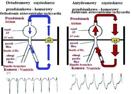 182 Aleksandra Stasiak i wsp. również zasłabnięcie czy omdlenie. Następstwem utrwalonego AVRT może być migotanie przedsionków, a także zatrzymanie krążenia w mechanizmie migotania komór.