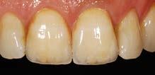Z Stainy do barwienia podbudowy cyrkonowej Kolor Dentyny Zirlux LC Kolor Brzegu siecznego Zirlux LC Z1 A1 Neutral Z3 A2 Light Z3 A3