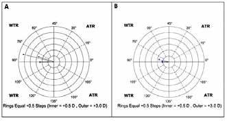 Tab. II. BCVA analysis in 3 surgical technique grous (reoeratively and 180 days ostoeratively) Wilcoxon test.