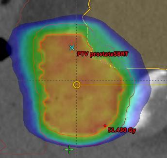 Biological Effective Dose (BED) Scaling α/β rectum = 6 Gy