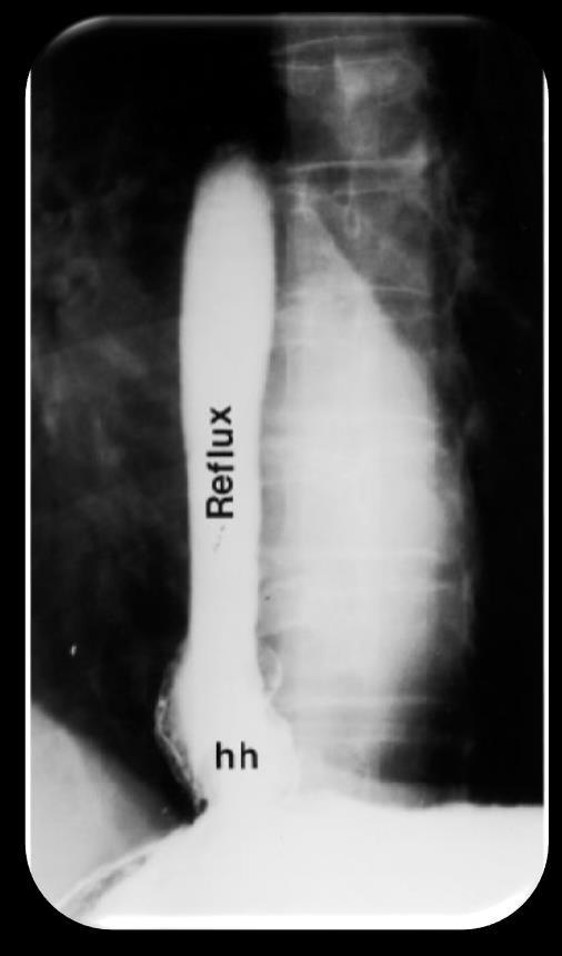 DIAGNOSTYKA RTG GOPP Z BARYTEM Nie jako badanie podstawowe, ale: Podejrzenie obecności nieprawidłowości anatomicznych Objawy obecne mimo leczenia