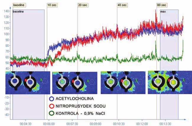 Choroby Serca i Naczyń 2014, tom 11, nr 1 Rycina 2. Rejestracja perfuzji mikrokrążenia metodą analizy kontrastu obrazu spekli laserowych.