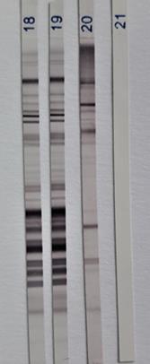 DIAGNOSTYKA NOWORODKÓW Analiza porównawcza IgG i IgM matki dziecka Obecność różnych wzorów przeciwciał / precypitacji u matki i