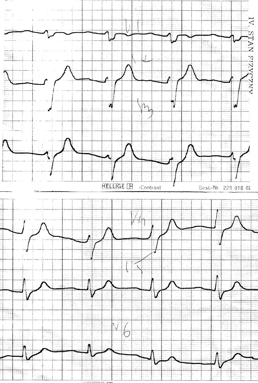 1304 Piotr Kukla et al. Tabela I. Charakterystyka zmian w EKG Czerwiec 1982 r. Wrzesień 1982 r. Wrzesień 2001 r.