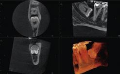 5 x Ø5 cm do diagnostyki miejscowej: Planowanie pojedynczych implantów